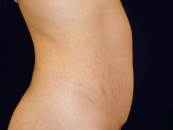Liposuction patient