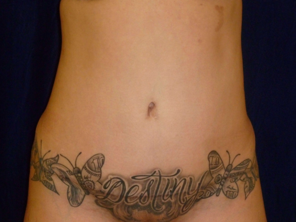 Liposuction patient