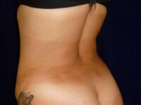 Liposuction patient