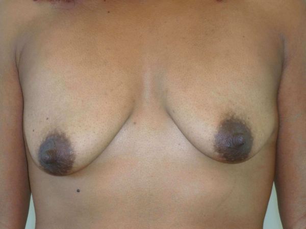 mommy makeover patient