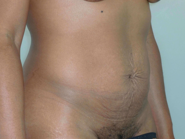 mommy makeover patient