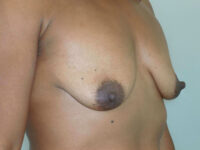 mommy makeover patient