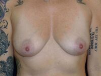 nonsurgical breast lift patient