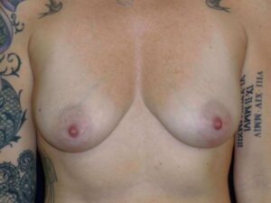 nonsurgical breast lift patient