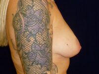 nonsurgical breast lift patient