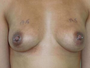 nonsurgical breast lift patient