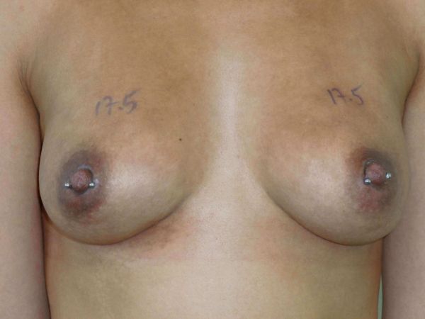 nonsurgical breast lift patient
