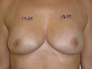 nonsurgical breast lift patient