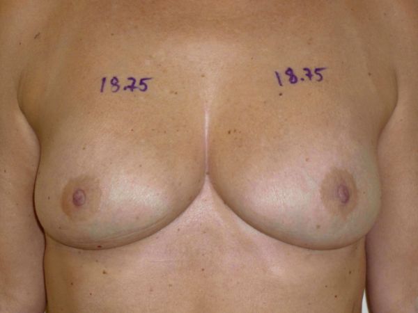 nonsurgical breast lift patient
