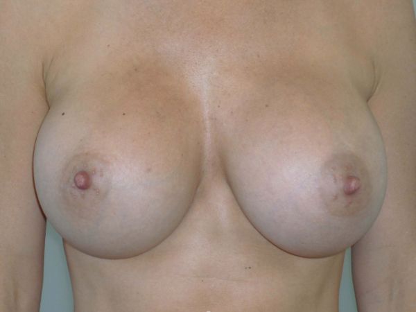 nonsurgical breast lift patient