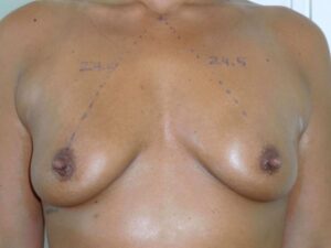 nonsurgical breast lift patient