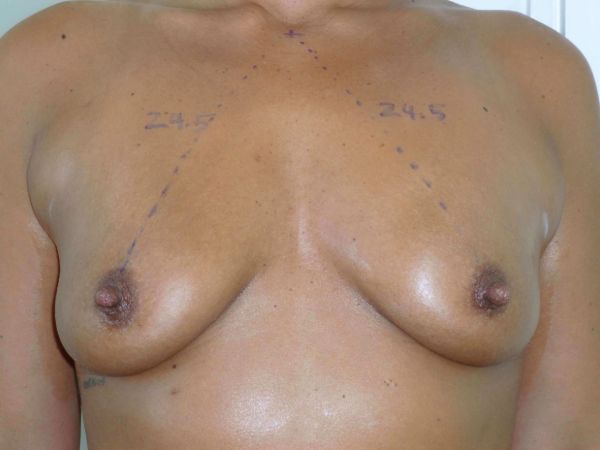 nonsurgical breast lift patient