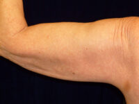 after nonsurgical skin tightening for left arm back view of female patient 2336