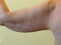 before nonsurgical skin tightening for left arm back view of female patient 2336