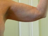 before nonsurgical skin tightening for left arm front view of female patient 2336