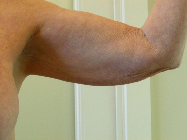 before nonsurgical skin tightening for left arm front view of female patient 2336