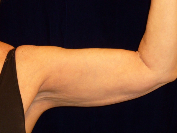 after nonsurgical skin tightening for left arm front view of female patient 2336