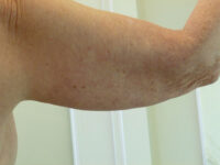 before nonsurgical skin tightening for right arm back view of female patient 2336