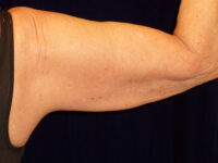 after nonsurgical skin tightening for right arm back view of female patient 2336