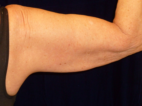 after nonsurgical skin tightening for right arm back view of female patient 2336