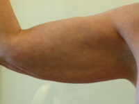 before nonsurgical skin tightening for right arm front view of female patient 2336