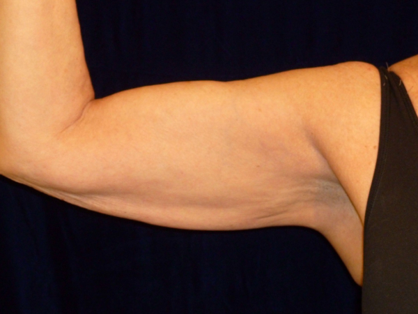 after nonsurgical skin tightening for right arm front view of female patient 2336