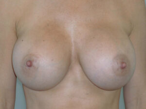 after nonsurgical skin tightening for body front view of female patient 2345