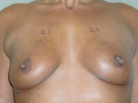 after nonsurgical skin tightening for body front view of female patient 2348