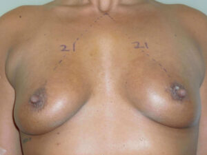 after nonsurgical skin tightening for body front view of female patient 2348