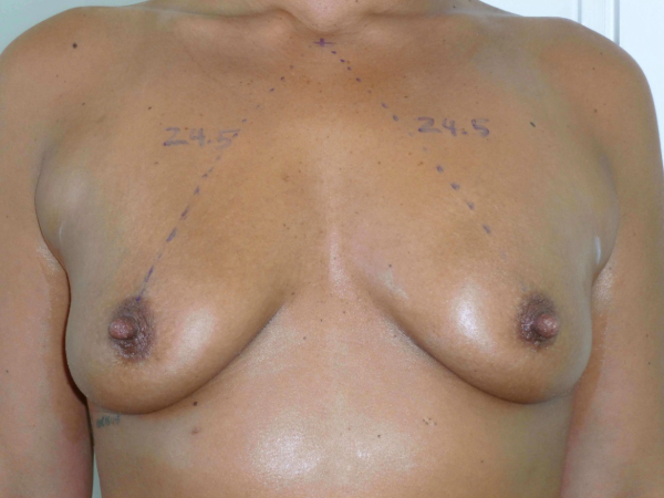before nonsurgical skin tightening treatment for body front view of female patient 2348