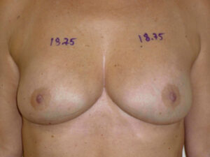 before nonsurgical skin tightening for body front view of female patient 2353