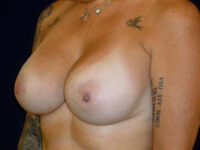 after nonsurgical skin tightening for body left angle view of female patient 2359