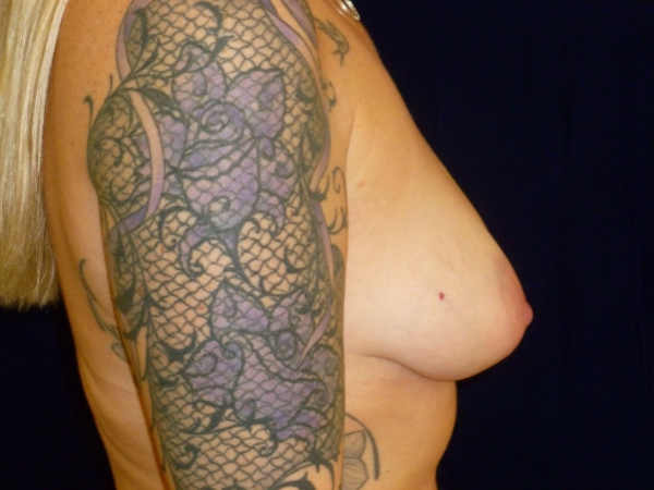 before nonsurgical skin tightening for body right side view of female patient 2359