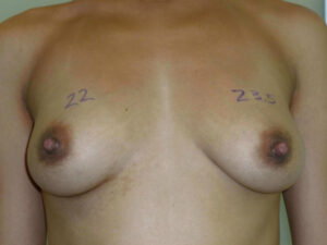 before nonsurgical skin tightening for body front view of female patient 2356