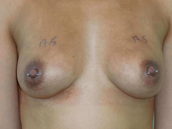 after nonsurgical skin tightening for body front view of female patient 2356