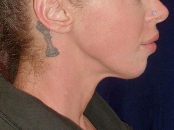 nonsurgical skin tightening for face patient