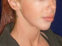 nonsurgical skin tightening for face patient