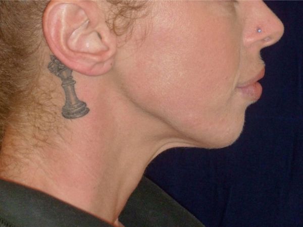 nonsurgical skin tightening for face patient