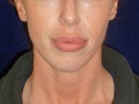 nonsurgical skin tightening for face patient