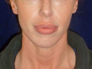 nonsurgical skin tightening for face patient