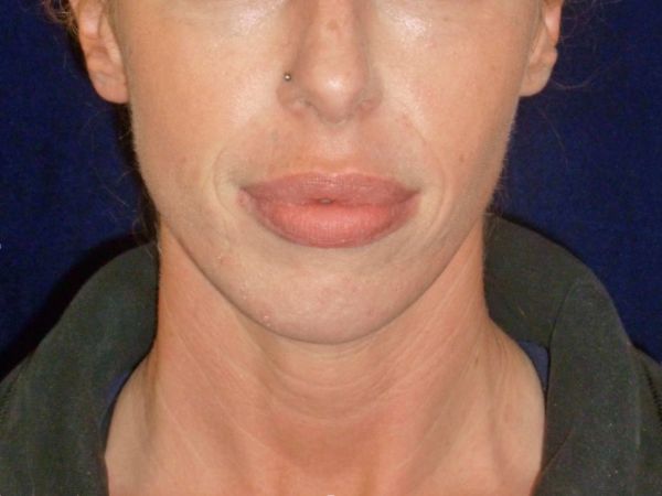 nonsurgical skin tightening for face patient