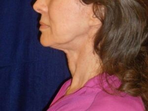 nonsurgical skin tightening for face patient
