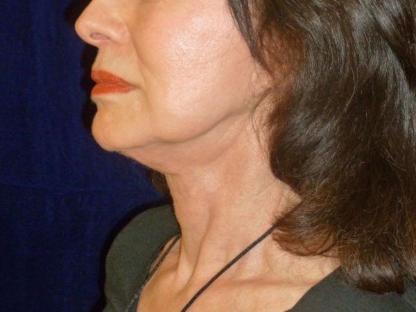 nonsurgical skin tightening for face patient