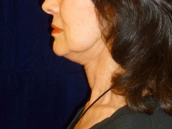 nonsurgical skin tightening for face patient