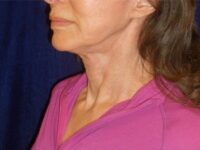 nonsurgical skin tightening for face patient