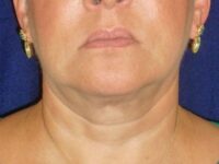 nonsurgical skin tightening for face patient
