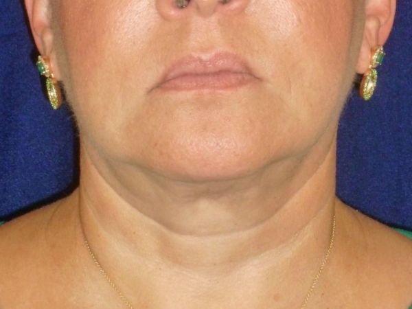 nonsurgical skin tightening for face patient