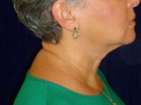 nonsurgical skin tightening for face patient