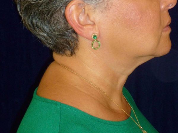 nonsurgical skin tightening for face patient