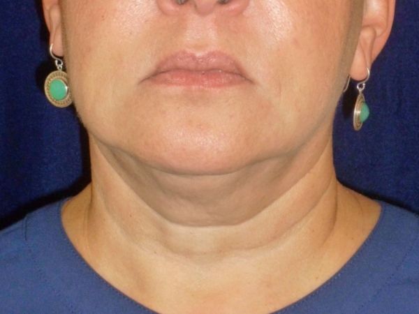nonsurgical skin tightening for face patient